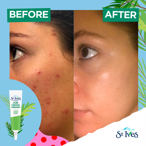 St. Ives Acne Control Tea Tree 22ml